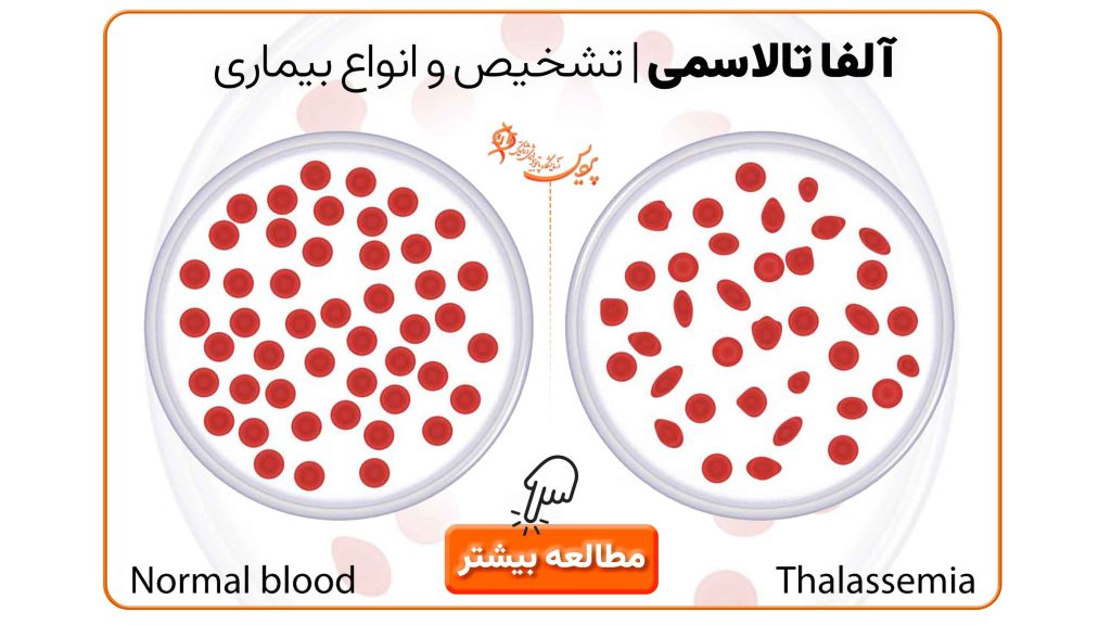 آلفا تالاسمی، تشخیص و انواع بیماری، آزمایش CBC و الکتروفورز هموگلوبین و ژنتیک