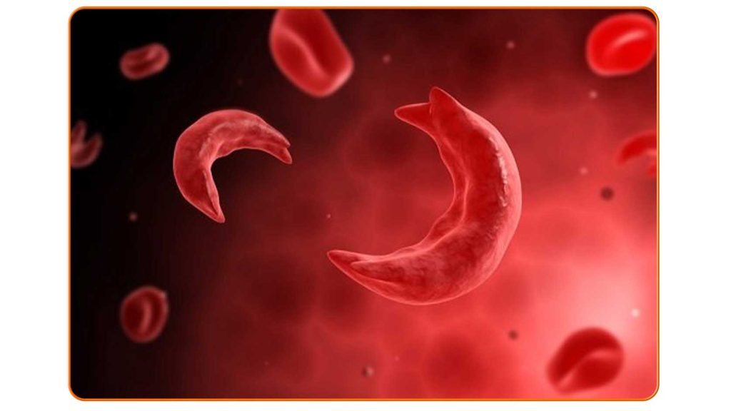 تصویر گلبول‌های قرمز داسی شکل در خون مربوط به آنمی سلول داسی شکل، بیماری ارثی کم‌خونی و اختلال در جریان خون.