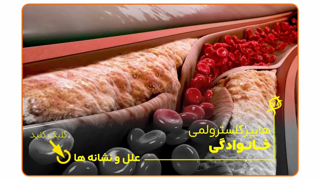 افزایش چربی در دیواره رگ‌ها در بیماری هایپرکلسترولمی خانوادگی